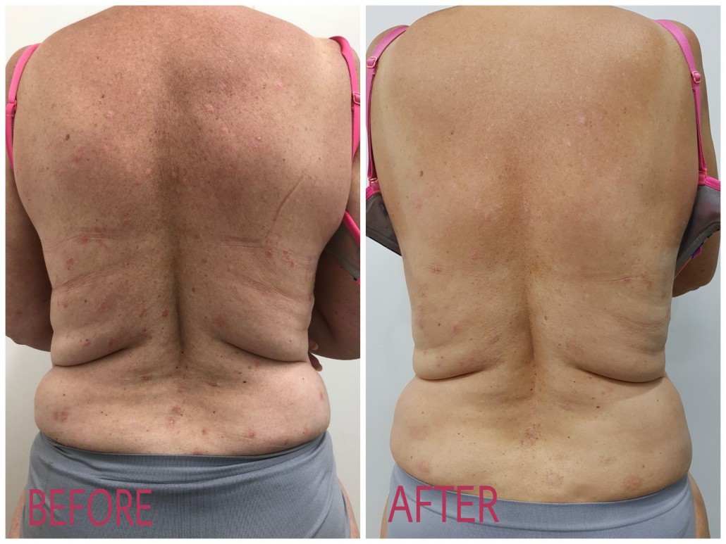 loose skin before and after RF skin tightening Jeune Ascot Vale
