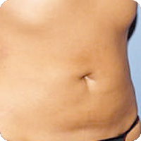 muffin top after fat freezing