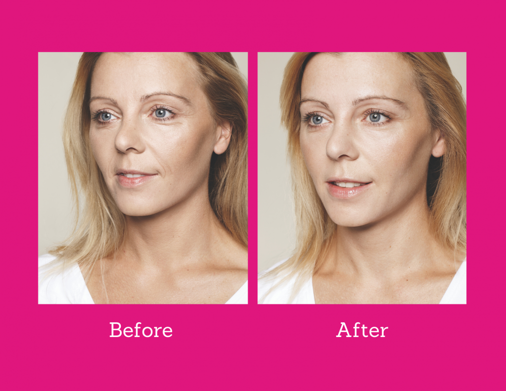 before and after pictures showing skin is more hydrated after applying hydrophilic hualuronic acid
