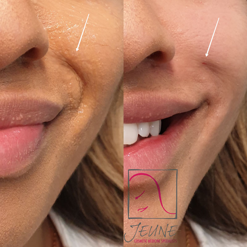 Lip Fillers Melbourne - Lip Injections - Lip Enhancement - Lip Augmentation