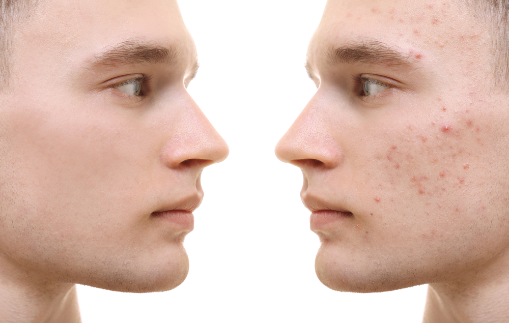 jawline contouring for men - Jeune Ascot Vale