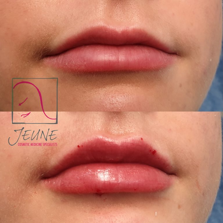 LIP FILLER AFTERCARE Do’s and Don’ts Jeune Ascotvale