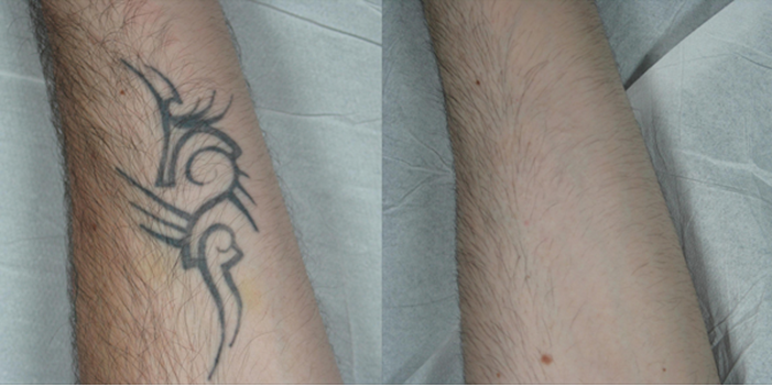 Tattoo Removal Melbourne, Laser Tattoo Removal - Jeune