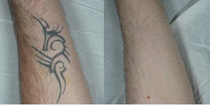 Tattoo Removal Before and After  Tannan Plastic Surgery