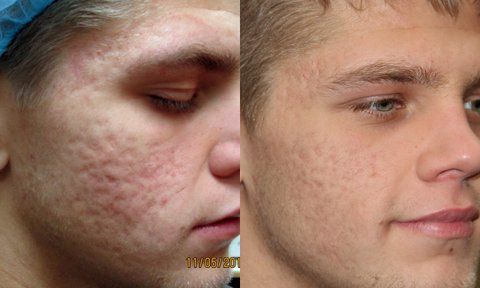 acne-before-after